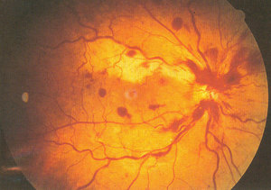 中心性視網膜靜脈阻塞