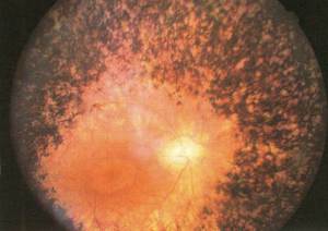 視網膜色素變性(夜盲症)