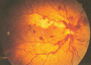 中心性視網膜靜脈阻塞